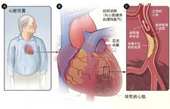 冠心病的起因是什么？