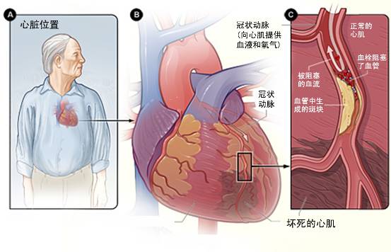 怎樣治療冠心??？(圖3)